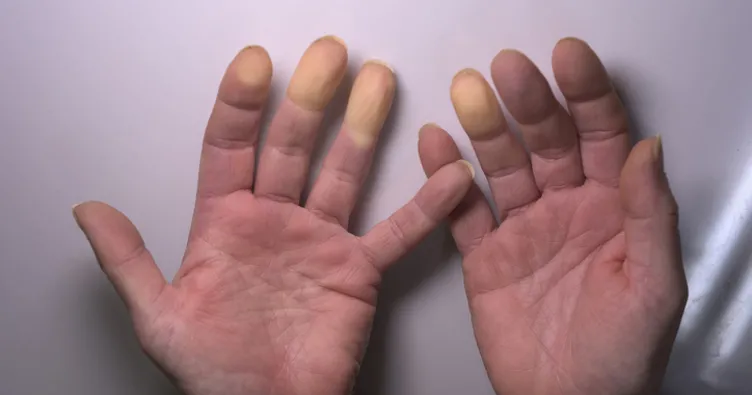Soğukta Moraran Parmaklar Raynaud Fenomeninin Habercisi Olabilir