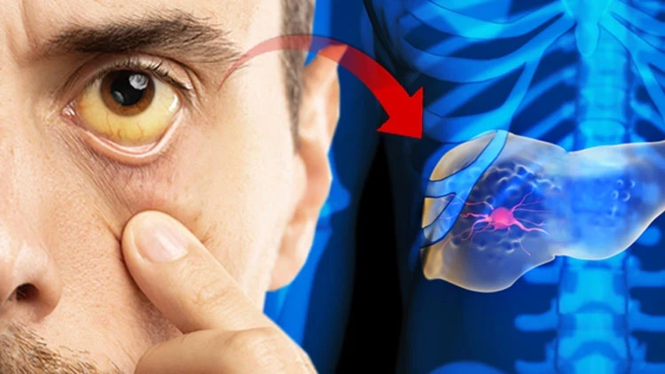 Hepatit D Sessizce İlerliyor Karaciğer İçin Ciddi Risk Oluşturuyor