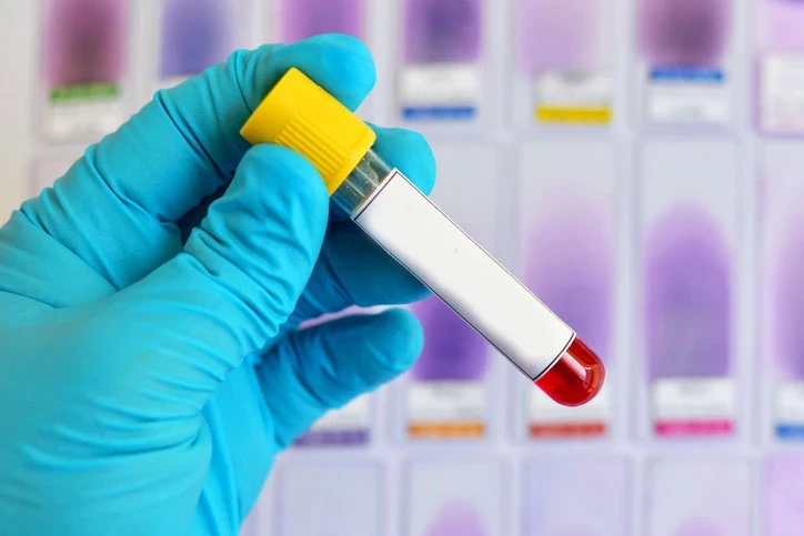 Alzheimer Riskini Yıllar Öncesinden Gösterebilecek Kan Testi İçin Umut Veren Araştırma