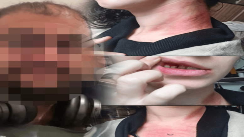 Boğazını Sıktı, Kafa Attı, Dişlerini Kırdı! Şikâyetçi Oldu, Serbest Dolaşıyor Boğazını Sıktı, Kafa Attı, Dişlerini Kırdı! Şikâyetçi Oldu, Serbest Dolaşıyor