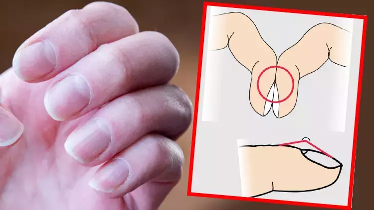 Akciğer Kanserinin Sessiz İşareti: Parmaklarda Çomaklaşmaya Dikkat!