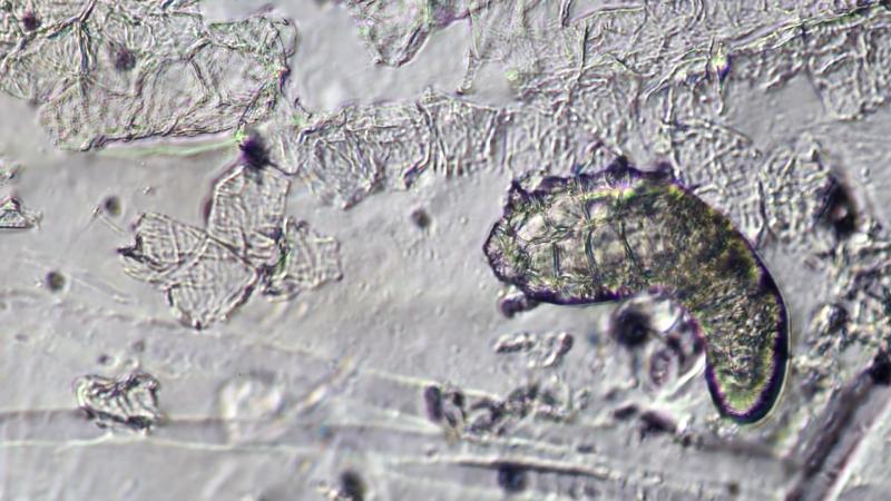 Siz Uyurken Yüzünüzde Yaşayan Demodex Akarları Ciltte Görev Başında Siz Uyurken Yüzünüzde Yaşayan Demodex Akarları Ciltte Görev Başında