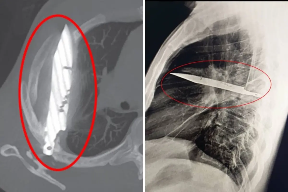 Göğüs Ağrısıyla Hastaneye Gitti, 8 Yıldır Bıçakla Yaşadığı Ortaya Çıktı