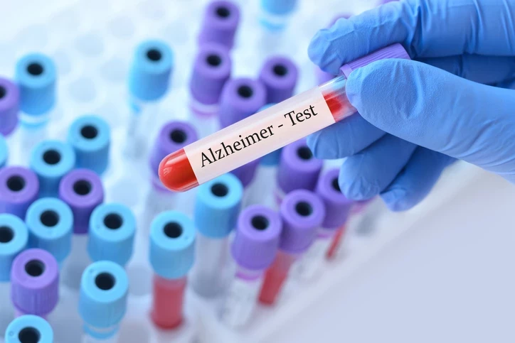Alzheimer Teşhisinde Devrim Burun Testi Hastalığı Yıllar Öncesinden Yakalayabilir
