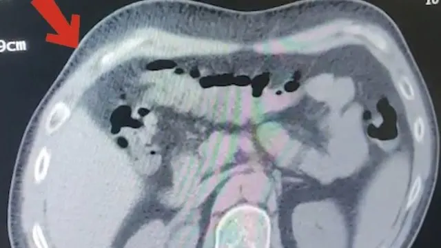 Tatvan’da Otobüs Yolcusunun Mide Ve Bağırsaklarında 608 Gram Metamfetamin Ele Geçirildi Tatvan’da Otobüs Yolcusunun Mide Ve Bağırsaklarında 608 Gram Metamfetamin Ele Geçirildi